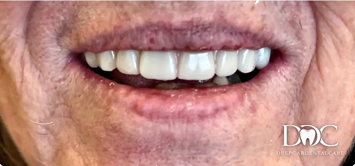 A patient’s smile after full-arch implant treatment