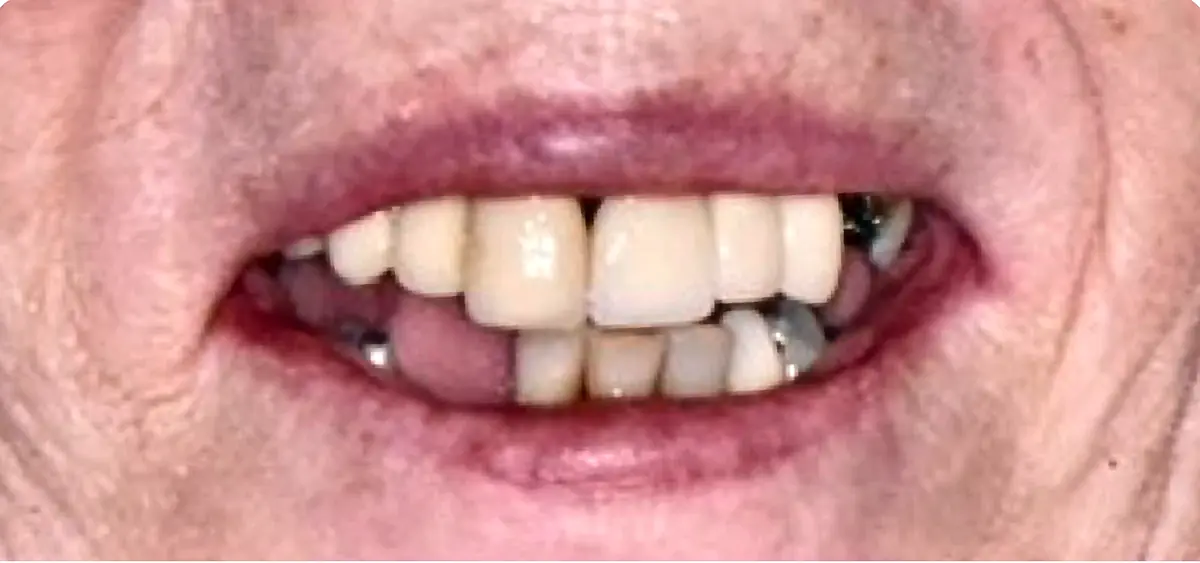 Before treatment: Failing upper teeth to a fixed full-arch bridge