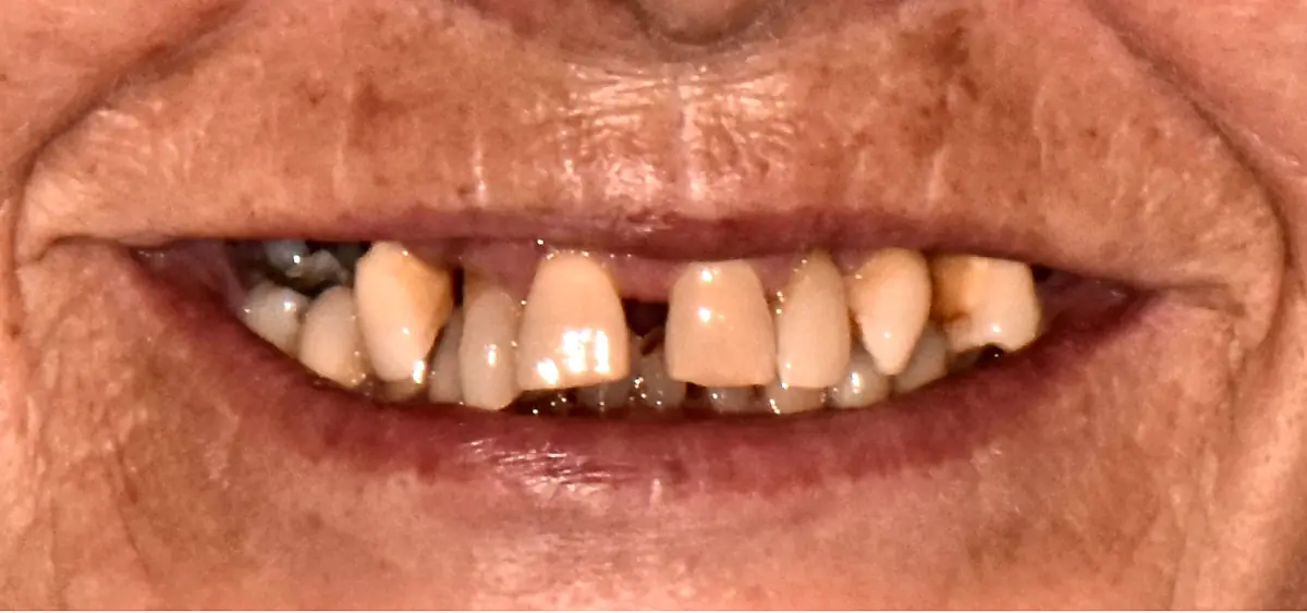 Before treatment: Worn, uneven front teeth restored
