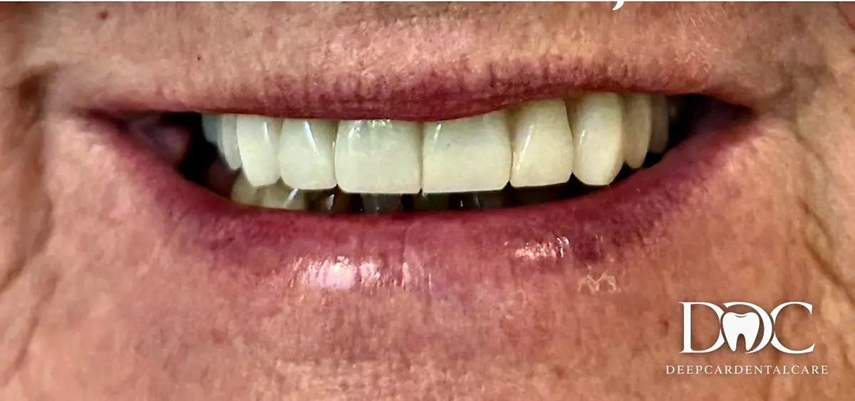 A patient’s smile after implants