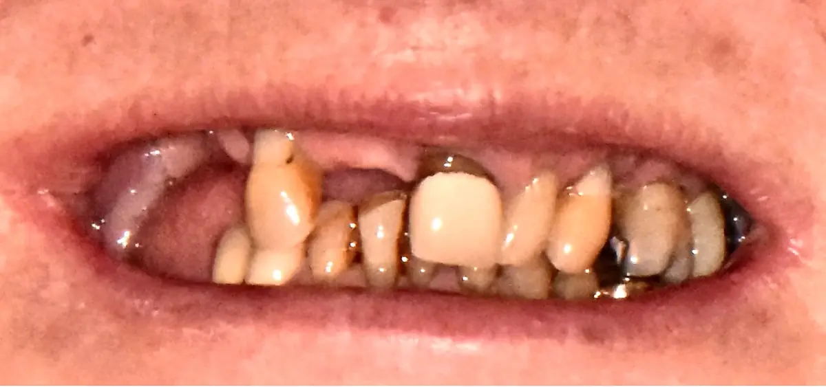 Before treatment: Multiple missing teeth replaced
