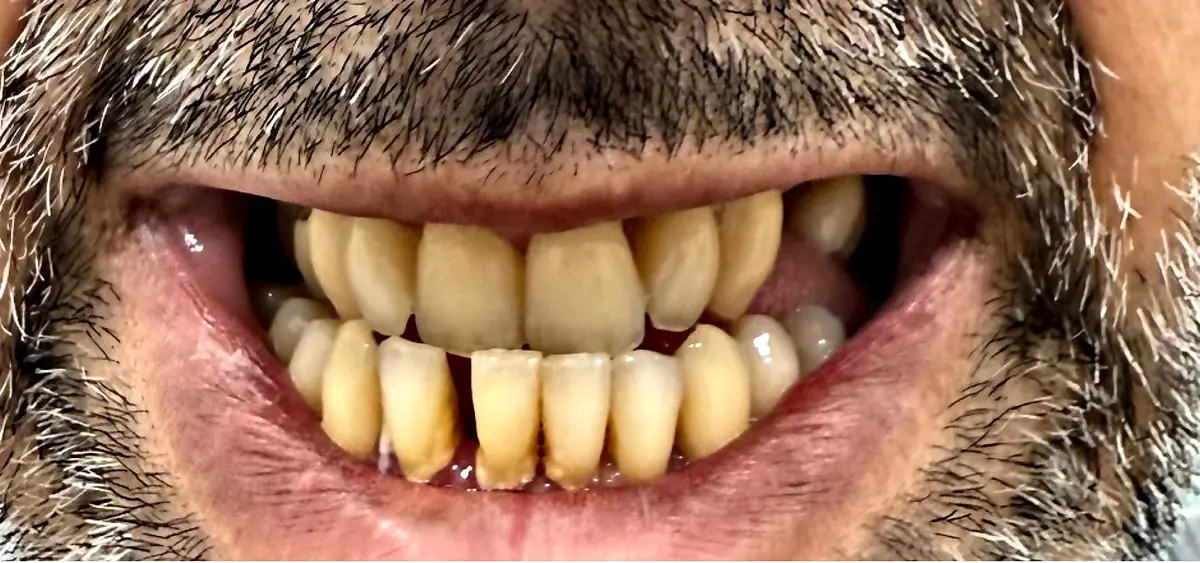 Before treatment: Discoloured, damaged teeth rebuilt